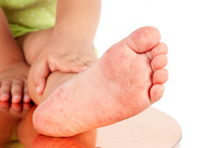 Những bệnh thường gặp ở trẻ nhỏ vào mùa hè - Ảnh 1.