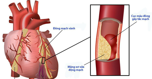 Biến chứng tim mạch của bệnh đái tháo đường - Ảnh 1.