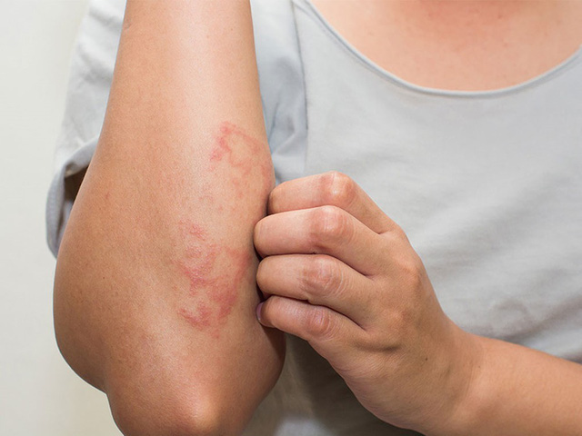 Bệnh chàm: nguyên nhân và cách điều trị - Ảnh 1.