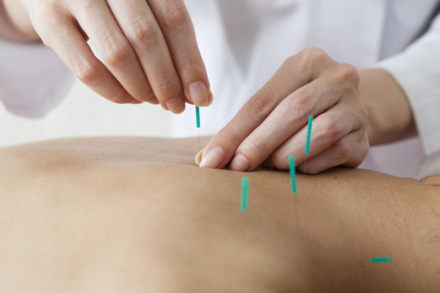 Nên thận trọng khi quyết định cấy chỉ - Ảnh 3.