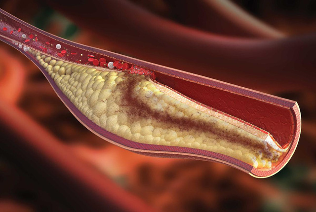 Báo động tỷ lệ người Việt Nam thừa cholesterol - Ảnh 1.