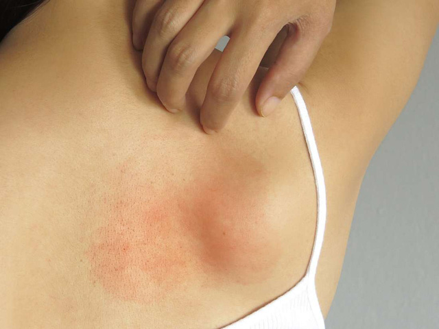 Dị ứng da mùa lạnh: nhiều thuốc không nên bôi thường xuyên - Ảnh 2.