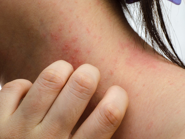 Dị ứng da mùa lạnh: nhiều thuốc không nên bôi thường xuyên - Ảnh 1.