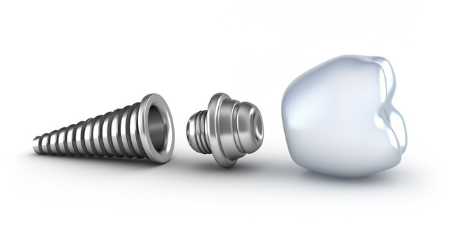 Trụ Implant nào tốt và phù hợp với bạn? - Ảnh 2.