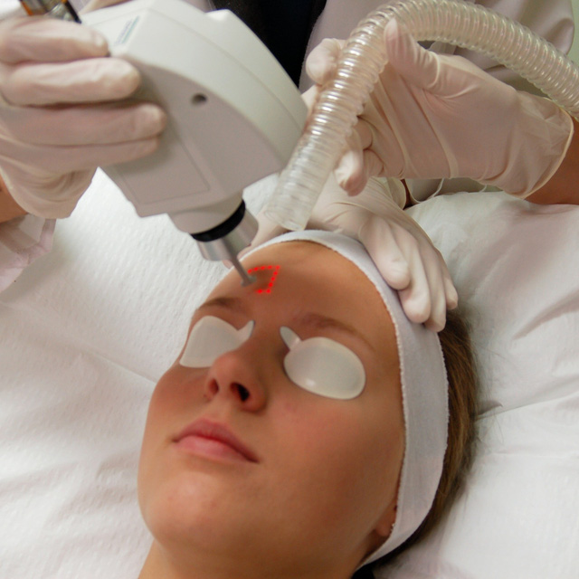 Cẩn trọng khi trị mụn, nám bằng tia laser - Ảnh 3.