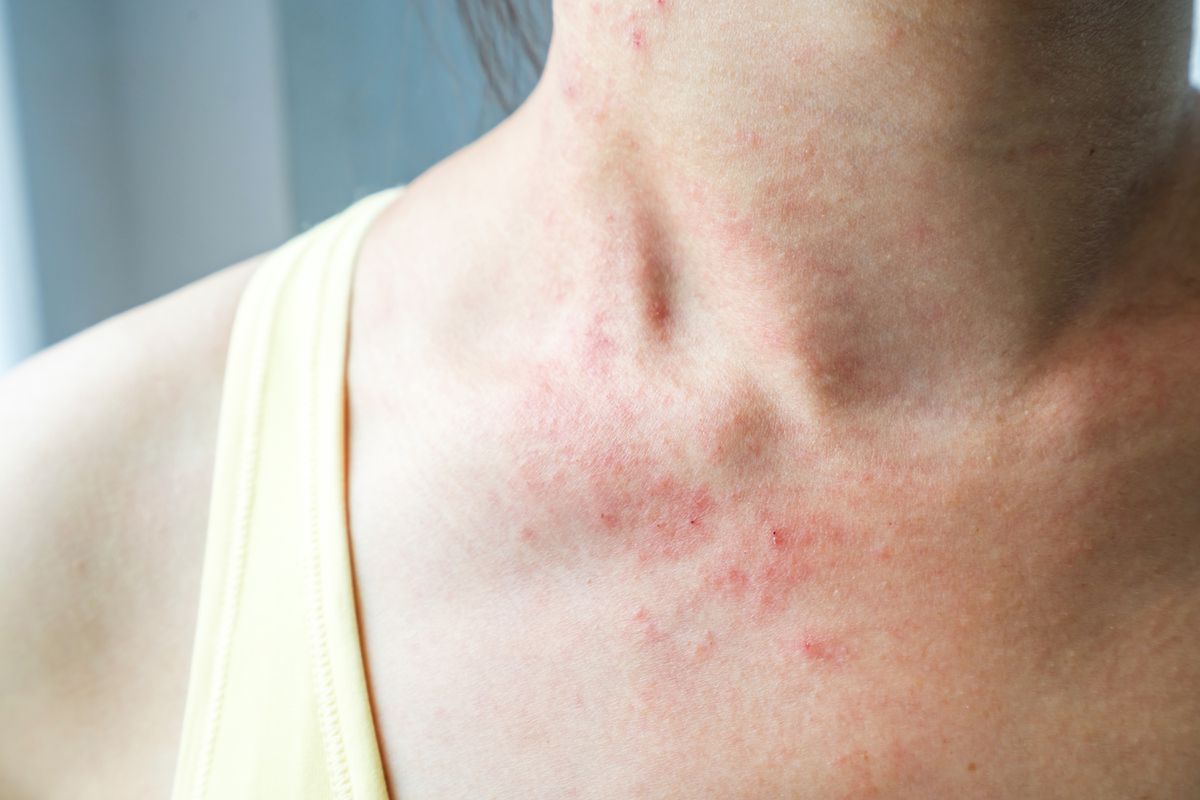 Một triệu chứng tr&ecirc;n da đ&aacute;ng ch&uacute; &yacute; kh&aacute;c l&agrave; ph&aacute;t ban dạng ch&agrave;m ở v&ugrave;ng cổ v&agrave; ngực thường c&oacute; m&agrave;u hồng v&agrave; c&oacute; thể ngứa.