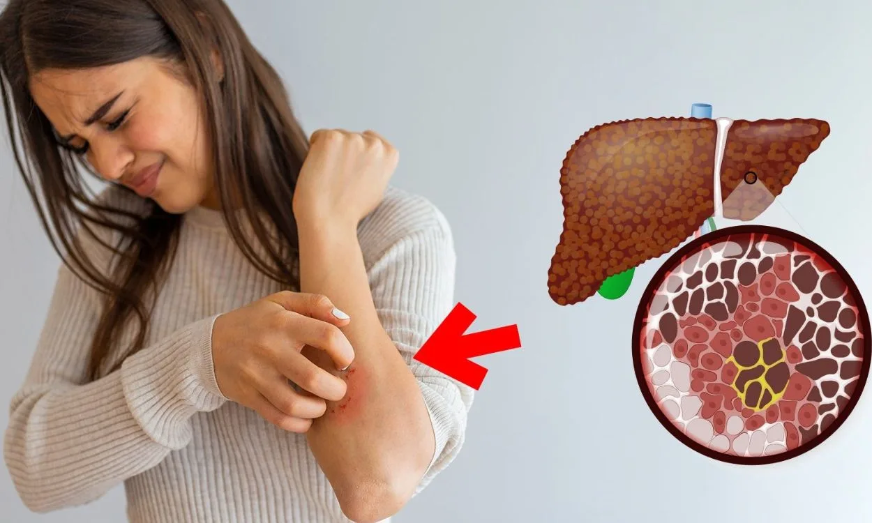 Sụt c&acirc;n kh&ocirc;ng r&otilde; nguy&ecirc;n nh&acirc;n, v&agrave;ng da, ngứa ng&aacute;y... c&oacute; thể l&agrave; triệu chứng của gan nhiễm mỡ.