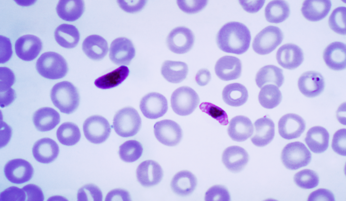 Sốt rét là bệnh truyền nhiễm do ký sinh trùng Plasmodium, lây truyền qua muỗi Anopheles.