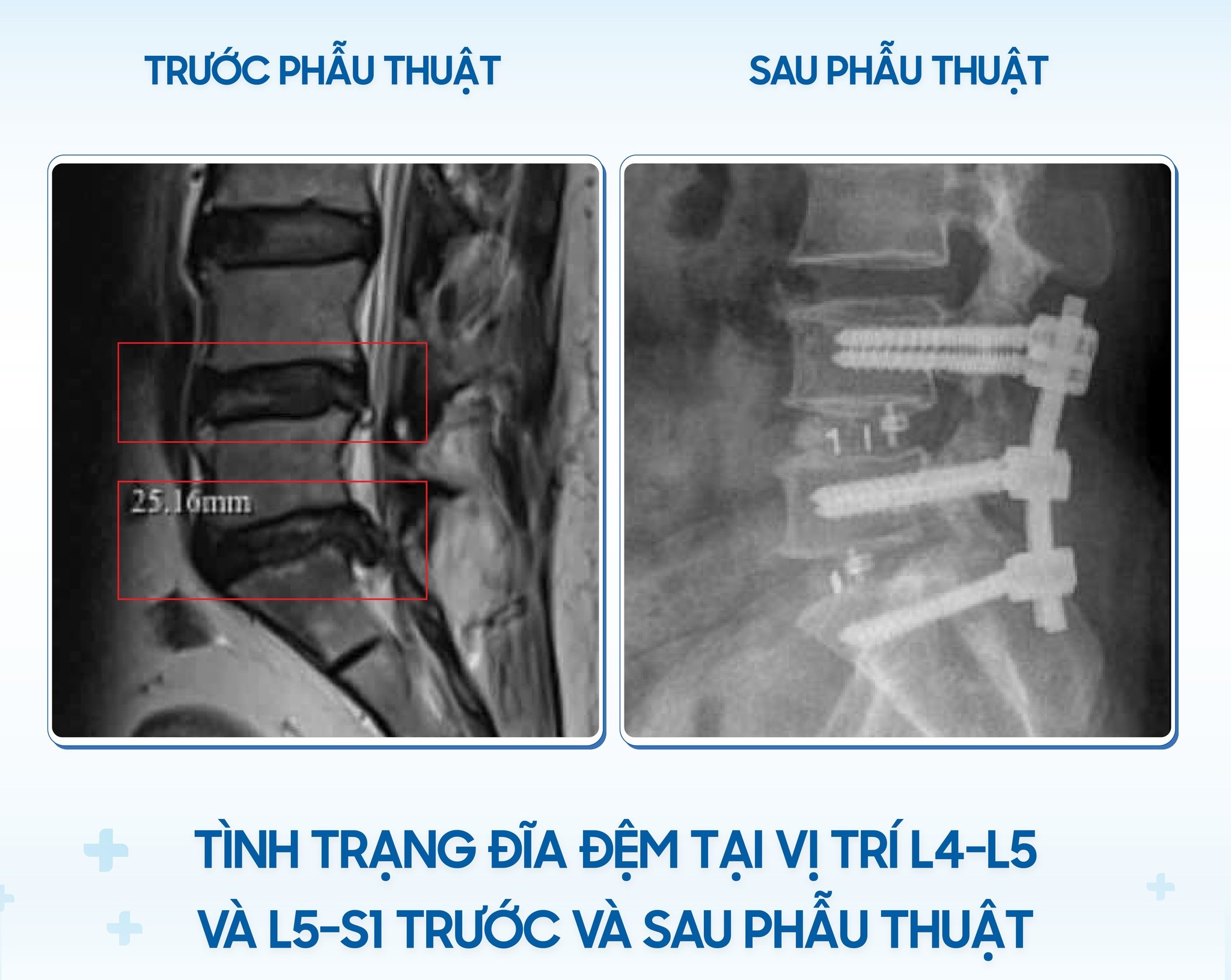 6PG88VN