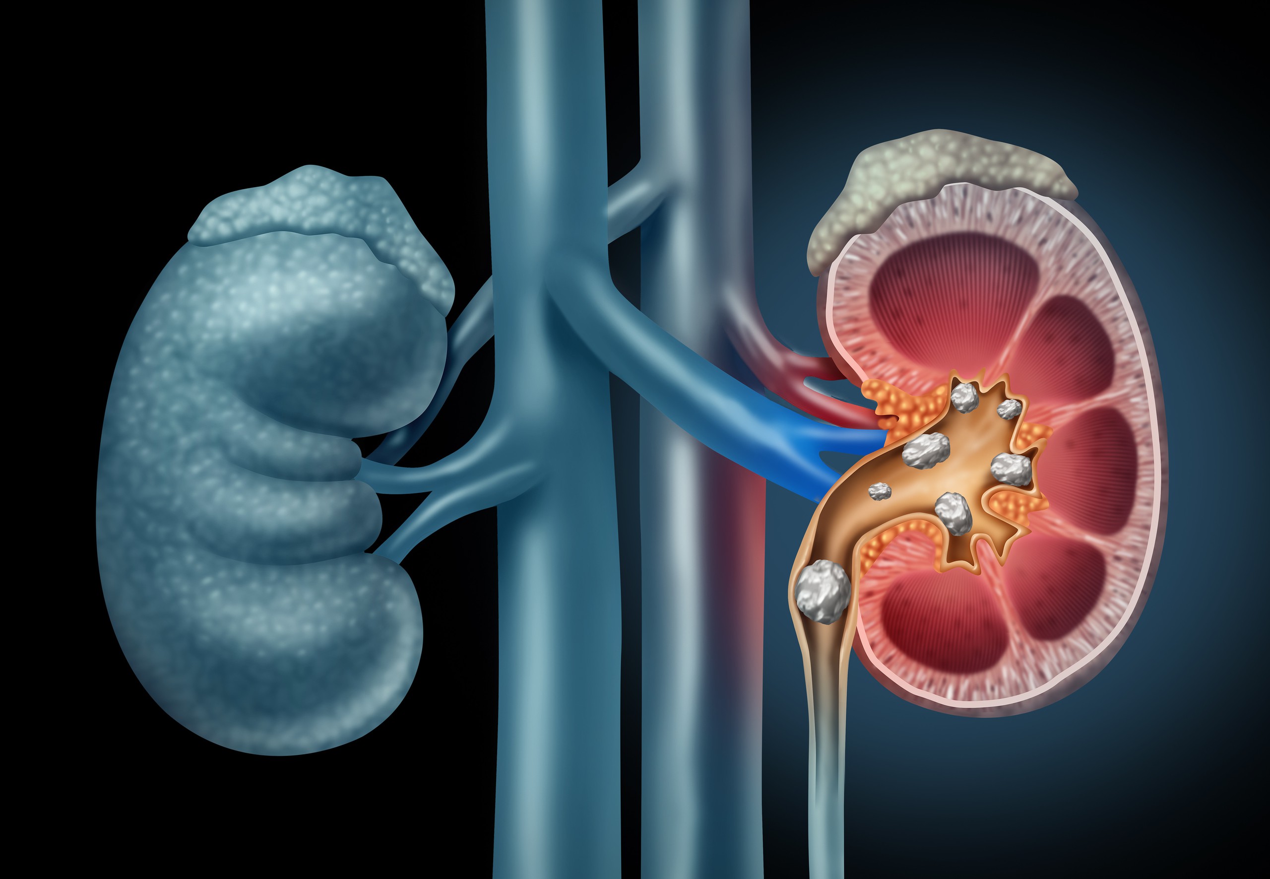 Việt Nam hiện là một trong những quốc gia có tỉ lệ mắc sỏi tiết niệu cao nhất thế giới.