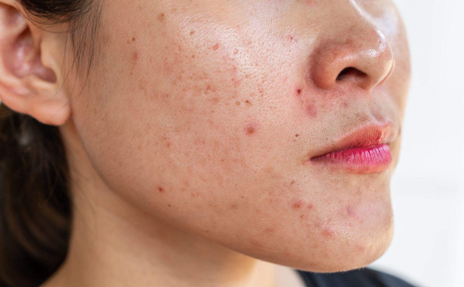 Vaccine trị mụn của Trung Quốc mang tính điều trị.