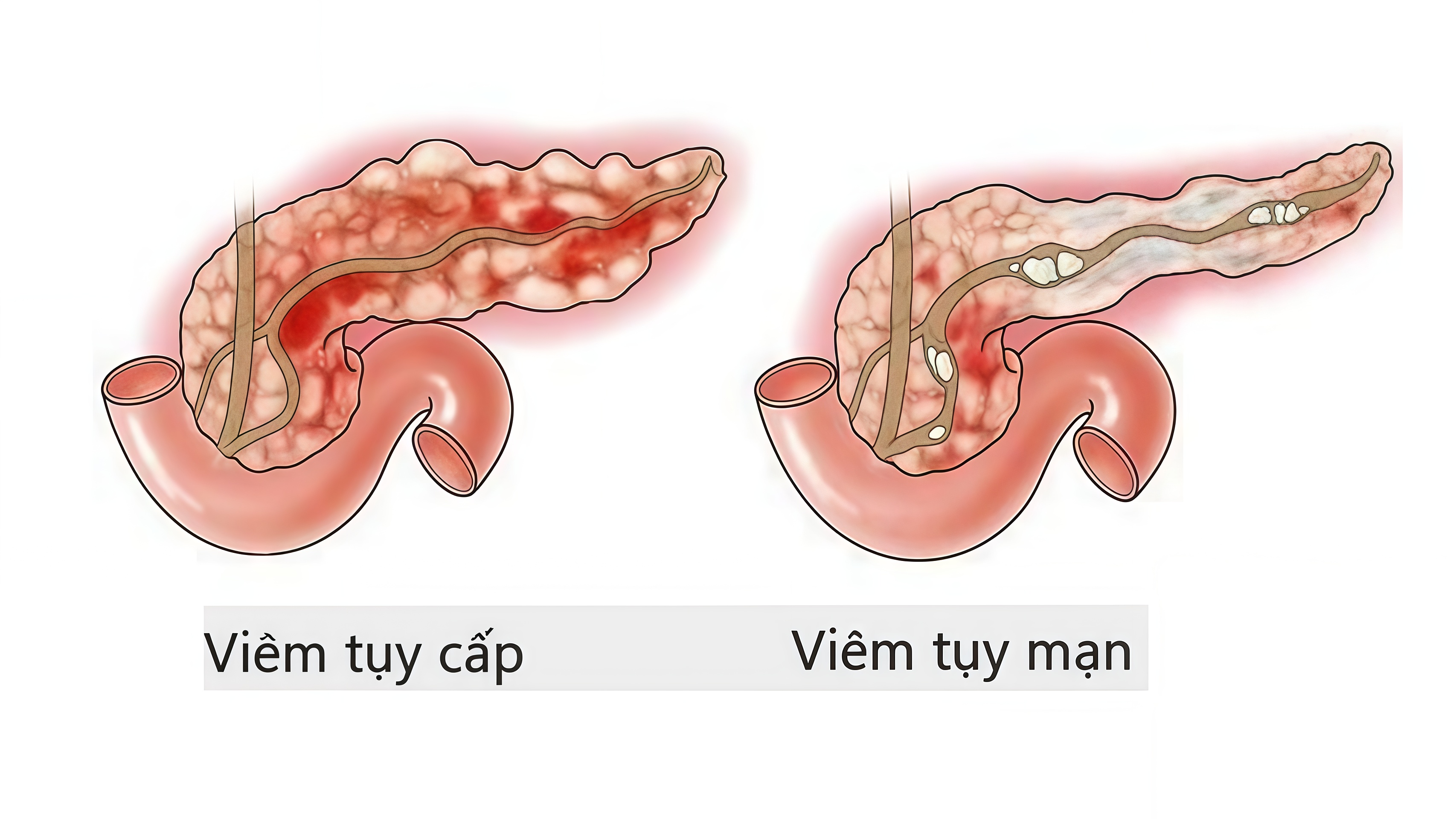 Viêm tụy cấp hiện vẫn là một trong những bệnh lý tiêu hóa nguy hiểm.