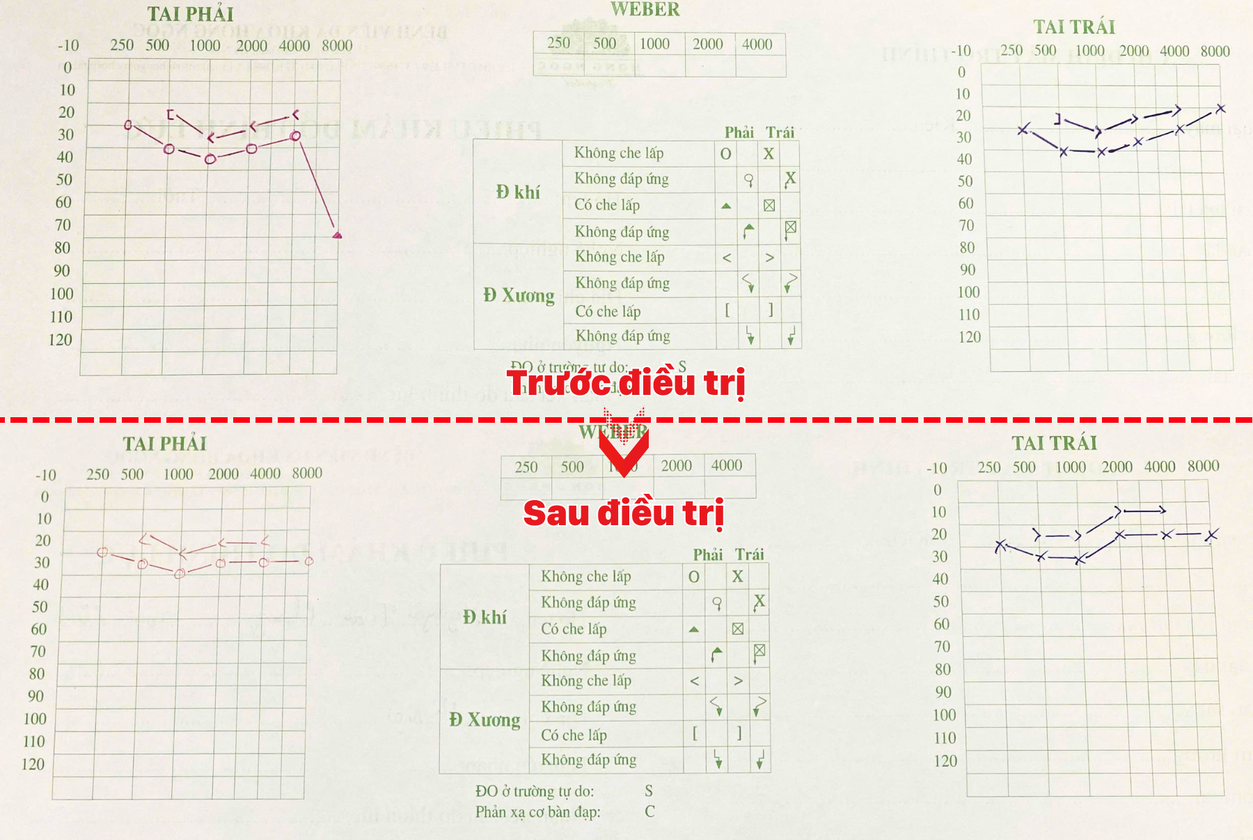 Kết quả đo thính lực đồ của bệnh nhân cải thiện rõ ràng một tuần điều trị.