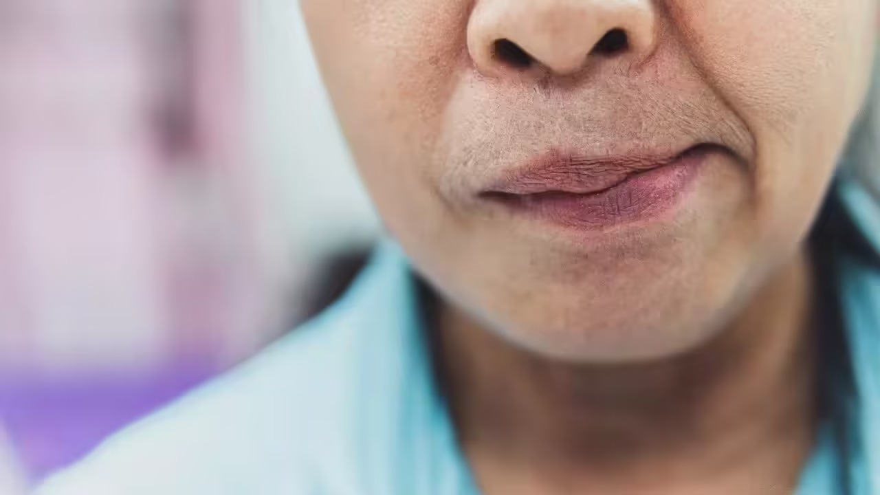 Từ tháng 5 đến tháng 7: Cảnh giác nguy cơ “liệt mặt” giữa mùa hè